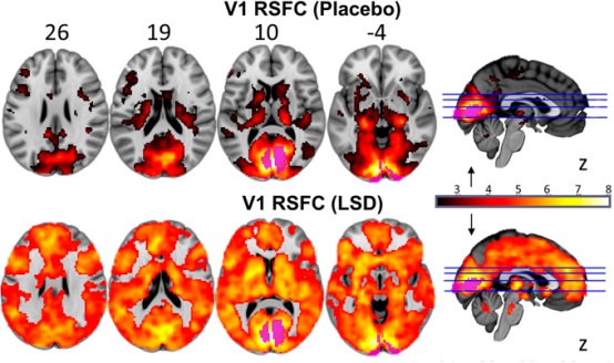 LSD brain scan
